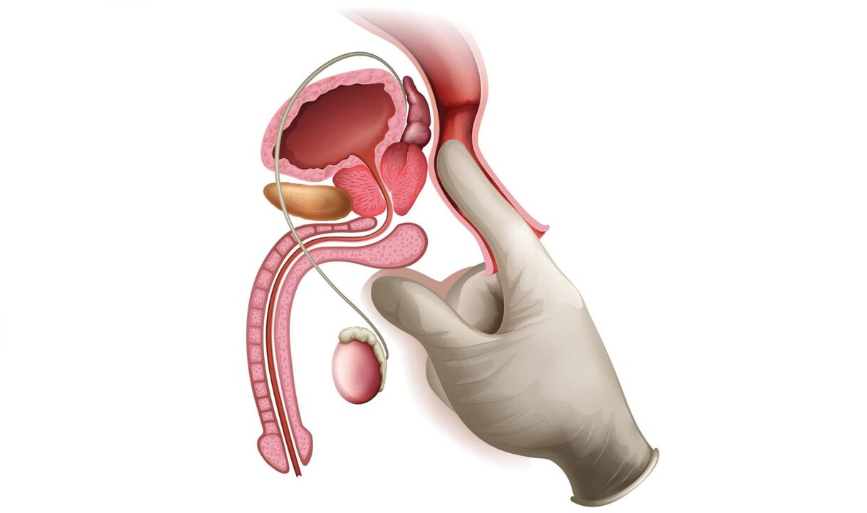 masaža prostate za prostatitis