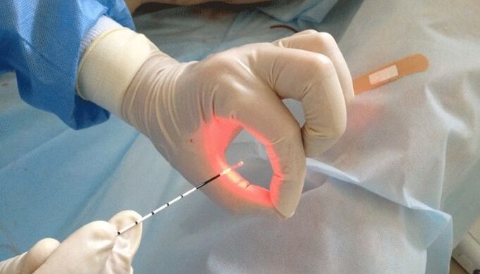 lasersko zdravljenje prostatitisa